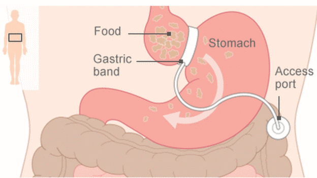  95048616 gastric band464