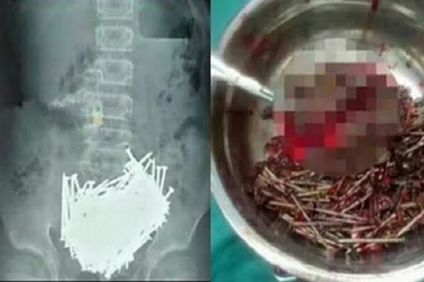 600 Nails Taken Out From stomach